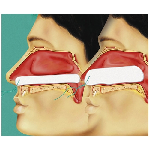 Nasal swab Raucocel for epistaxis - 100 mm